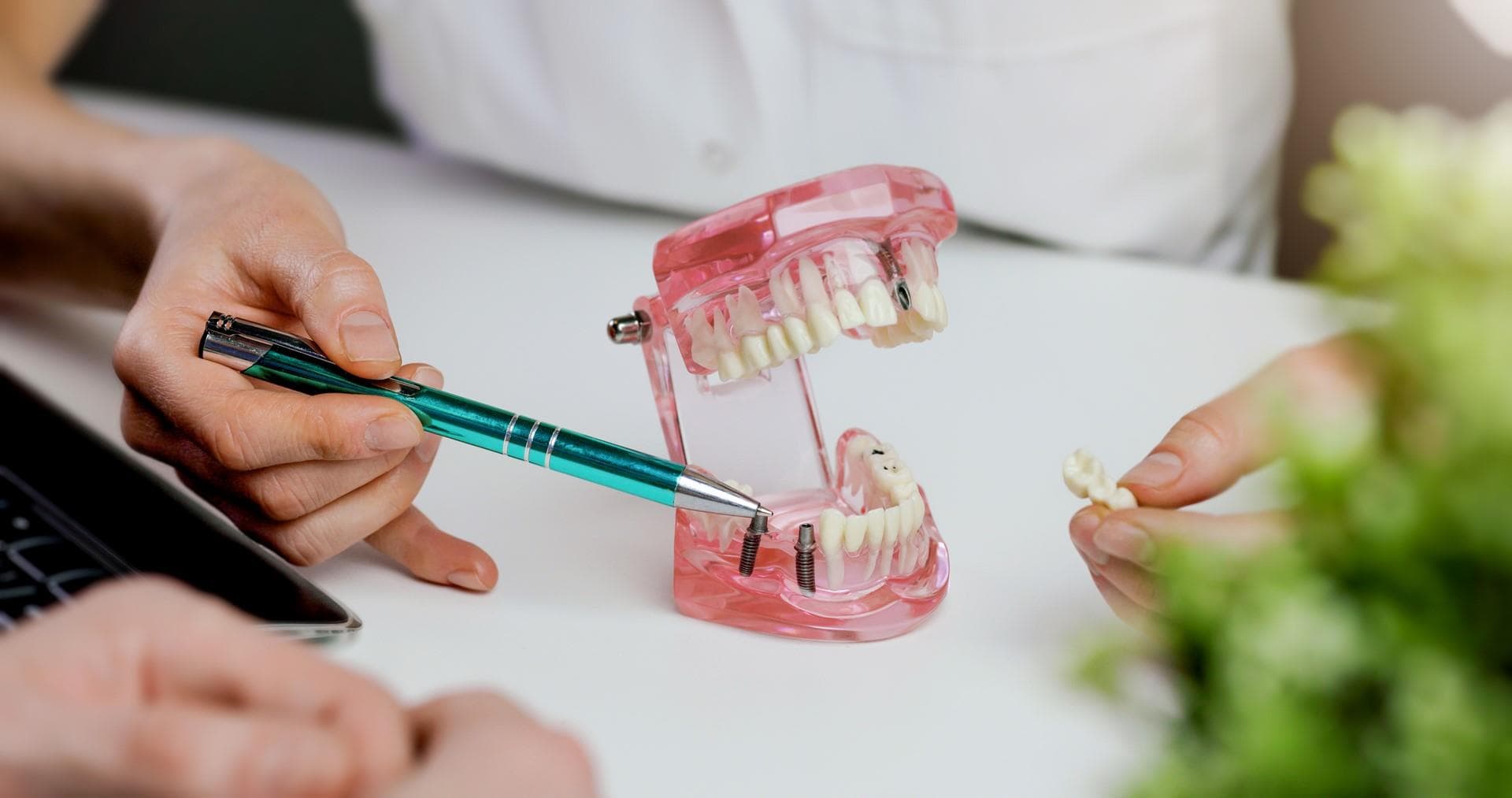 Dentistas especializados en implantes dentales